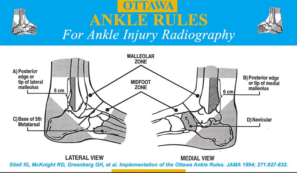 Image of ottowa ankle rules used in online urgent care evaluation of ankle injuries