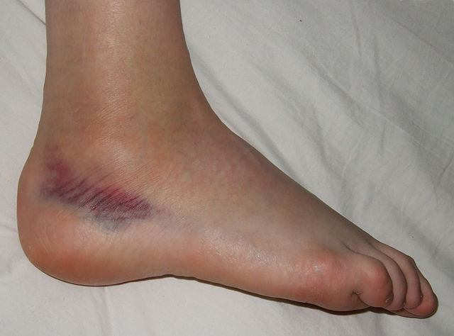 Dark bruise near ankle at the heel of foot