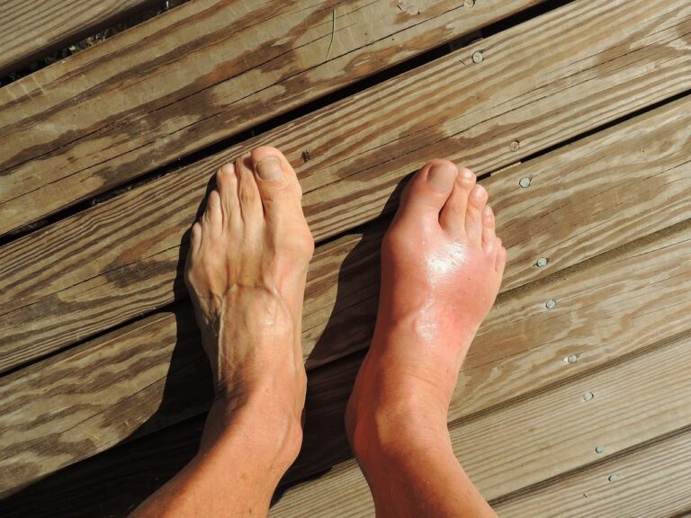 Image of feet from above with right foot red and swollen from Gout. Used in blog for online gout treatment.